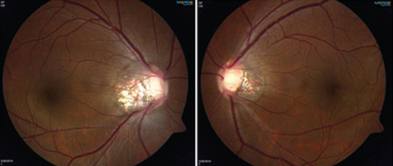 Stem Cell Therapy for Optic Nerve Atrophy in Malaysia